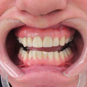 Denture Tooth Placement
