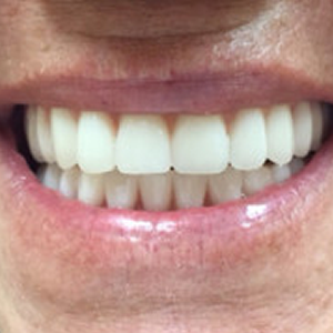 Dentures falling out