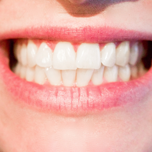 Denture reline kit